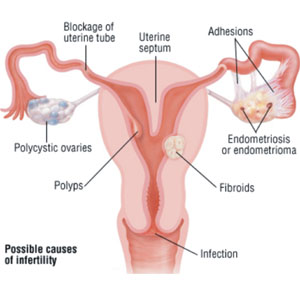 Infertility in women