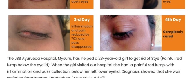 The JSS Ayurveda Hospital, Mysuru, has helped a 23-year-old girl to get rid of Stye (Painful red lump below the eyelid). When the girl visited our hospital she had a painful red lump, with inflammation and puss collection, below her left lower eyelid. Diagnosis showed that she was suffering from Internal Hordeolum / Stye (ಕಣ್ಣು ಕುಟರೆ).